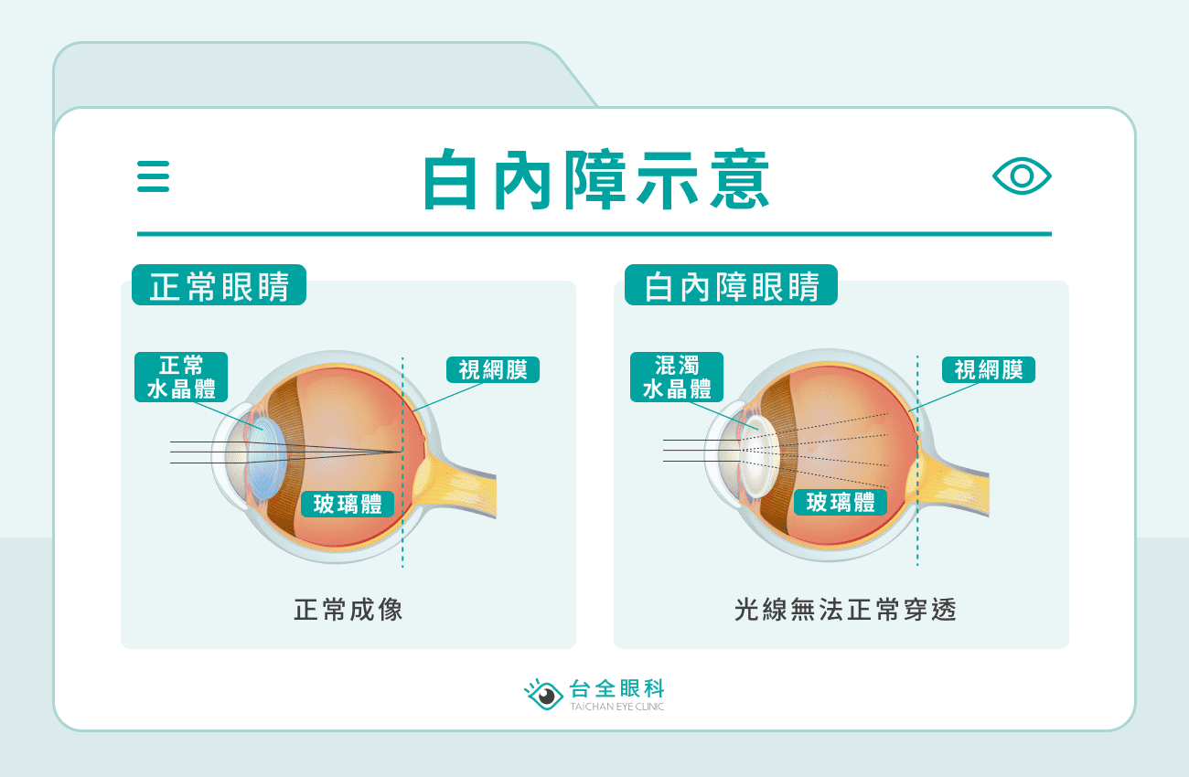 白內障示意