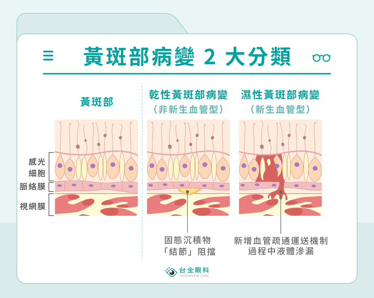 黃斑部病變 2 大分類