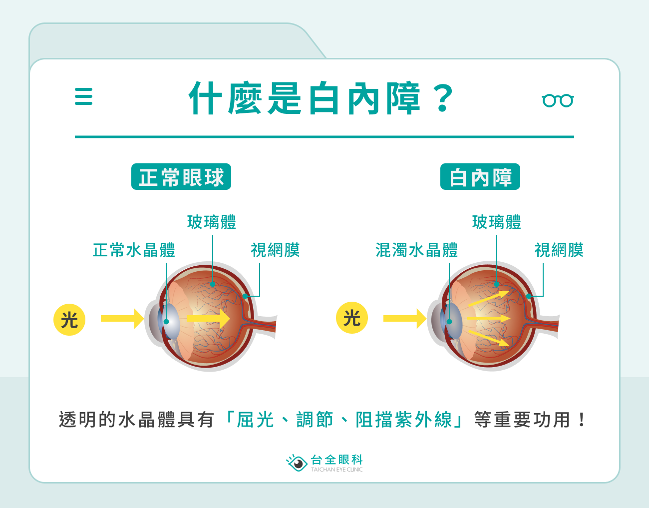 白內障是什麼？