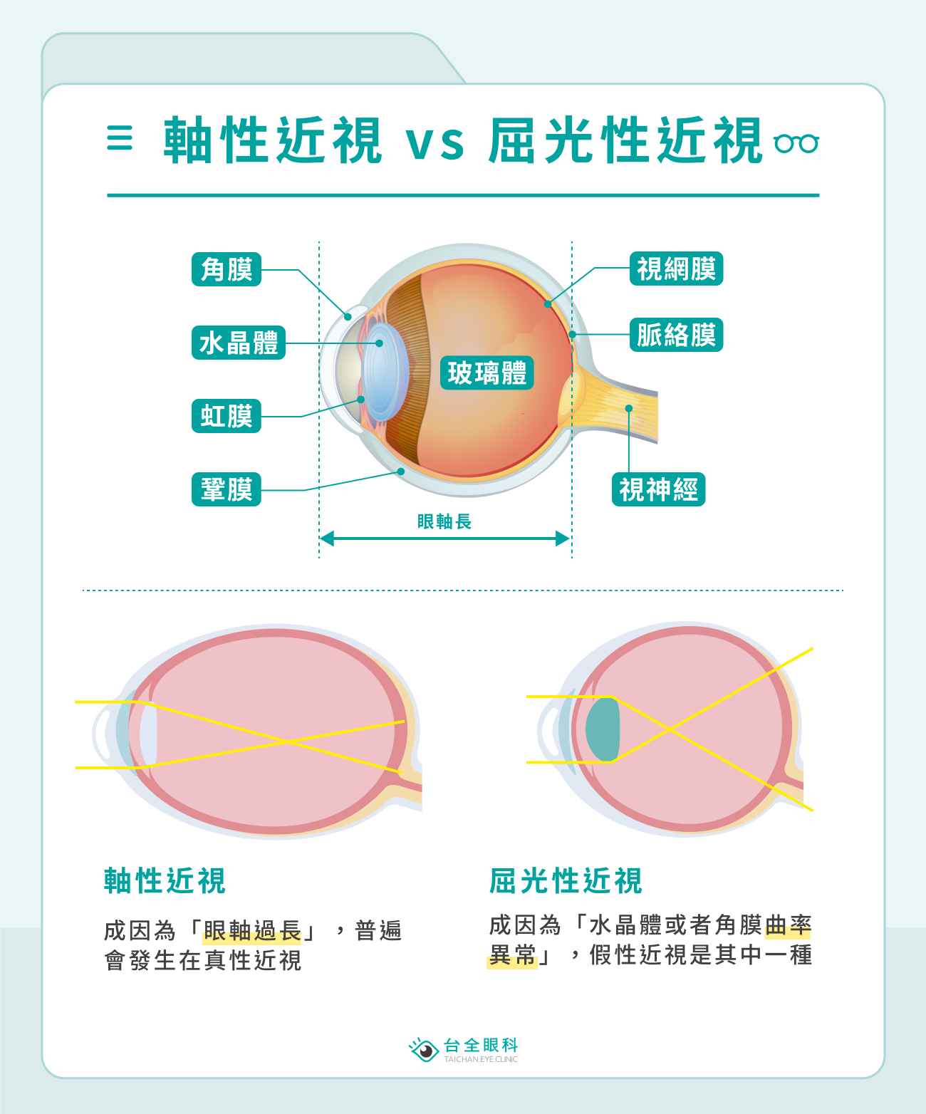 軸性近視 vs 屈光性近視